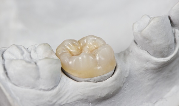 Dental Restorations Calgary | Evolution Dental